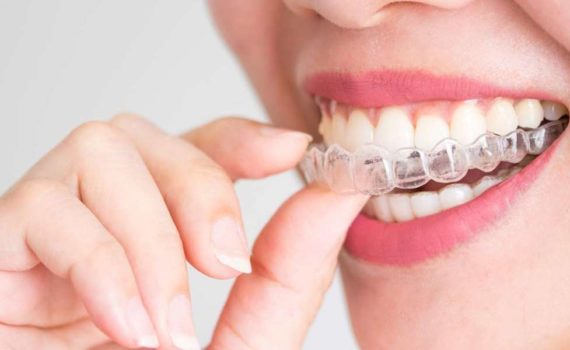 Teeth Grinding Protector Top 10 Rankings